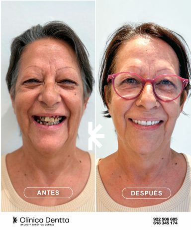 Rehabilitación protésica realizada en Clinica Dentta, en Candelaria