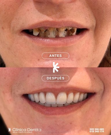 Rehabilitación protésica realizada en Clinica Dentta, en Candelaria