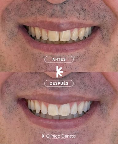Blanqueamiento dental realizado en Clinica Dentta, en Candelaria
