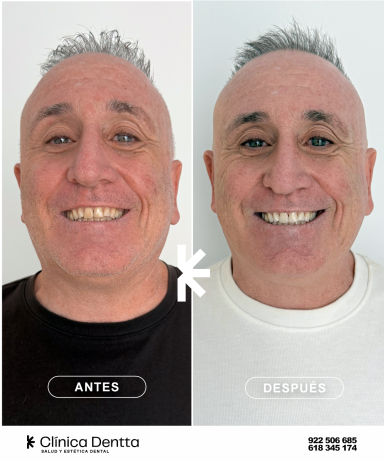 Blanqueamiento dental