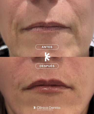 Armonización facial del tercio inferior