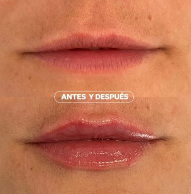 Armonización facial del tercio inferior realizado en Clinica Dentta, en Candelaria