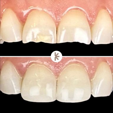Reconstrucciones estéticas realizadas en Clinica Dentta, en Candelaria