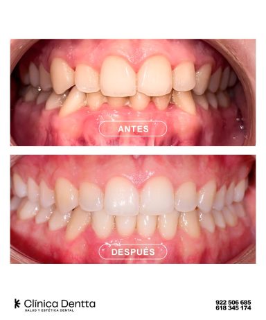 Ortodoncia con Invisalign en Clínica Dentta, en Candelaria